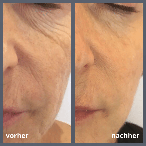 Behandlung Akne in Thüringen MK Beauty Art Academy