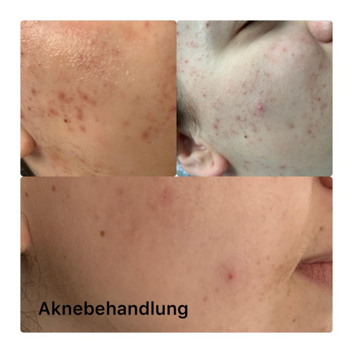 Aknebehandlung Bad Langensalza MK Beautyart
