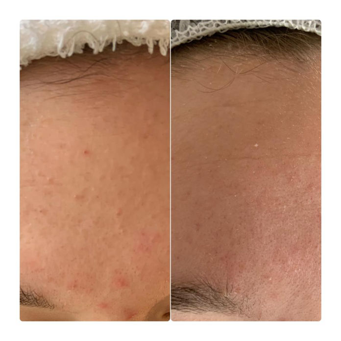 Aknebehandlung in Thüringen MK Beauty Art Academy