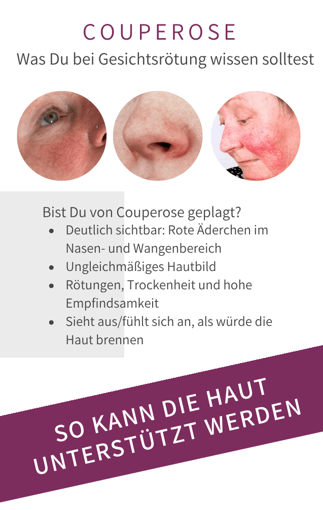 Couperose Rosacea Bad Langensalza Behandlung
