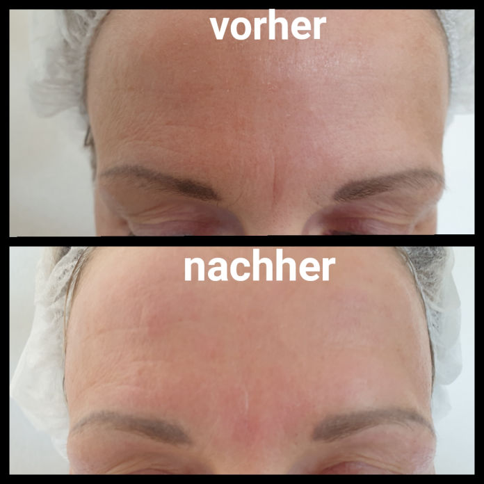 Needling Stirn Zornesfalte Studio Bad Langensalza MK Beautyart Academy