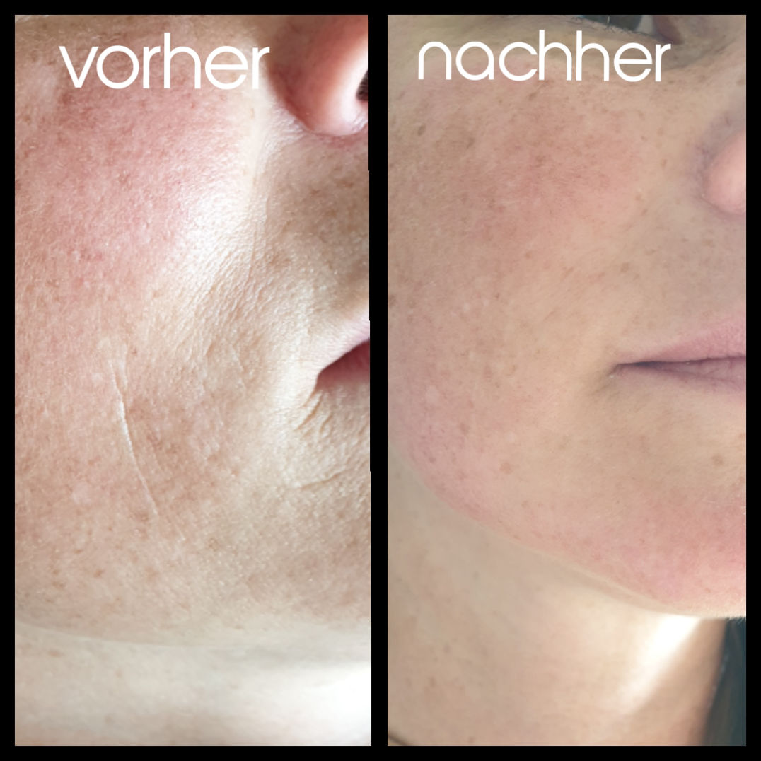 Microneedling Bad Langensalza