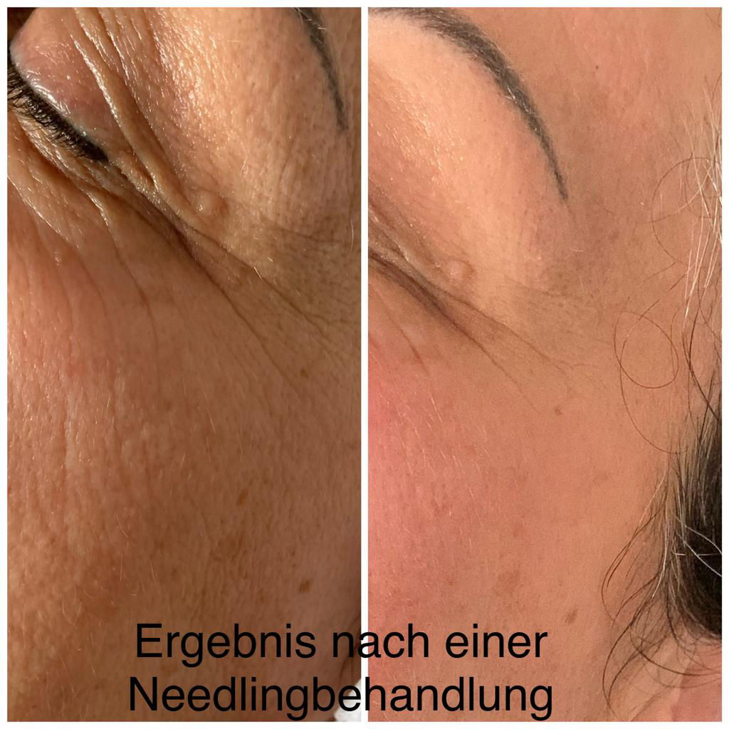 Nachbehandlung Microneedling in Thüringen MK Beauty Art Academy