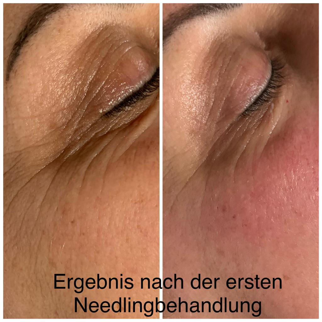 Nachbehandlung Microneedling in Thüringen MK Beauty Art Academy