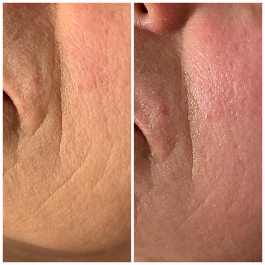 Nachbehandlung Microneedling in Thüringen MK Beauty Art Academy