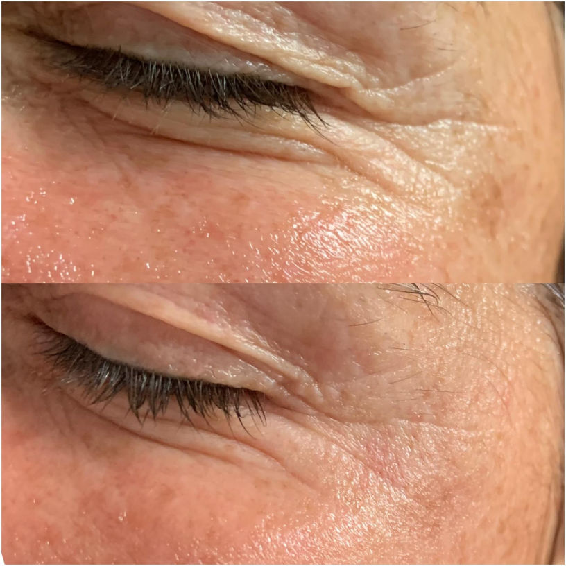 FUTURACONTOUR® Antiaging ohne Nadeln Thüringen Studio MK Beauty Art Bad Langensalza