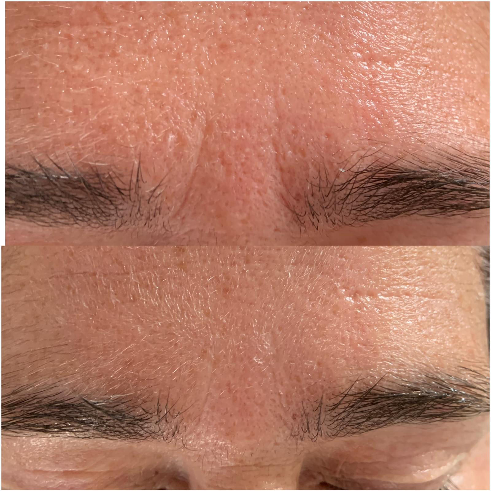 FUTURACONTOUR® Antiaging ohne Nadeln Thüringen Studio MK Beauty Art Bad Langensalza