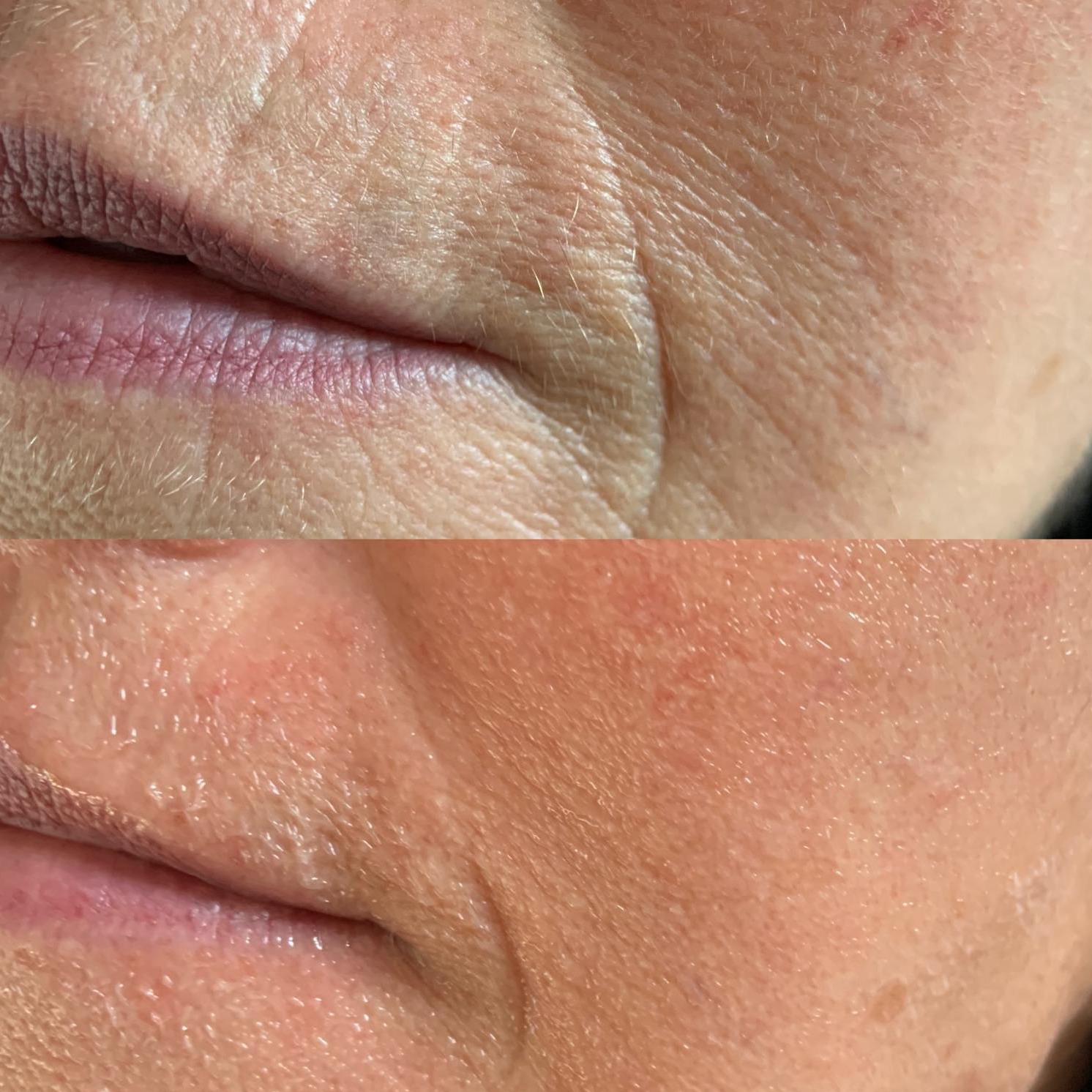 FUTURACONTOUR® Antiaging ohne Nadeln Thüringen Studio MK Beauty Art Bad Langensalza