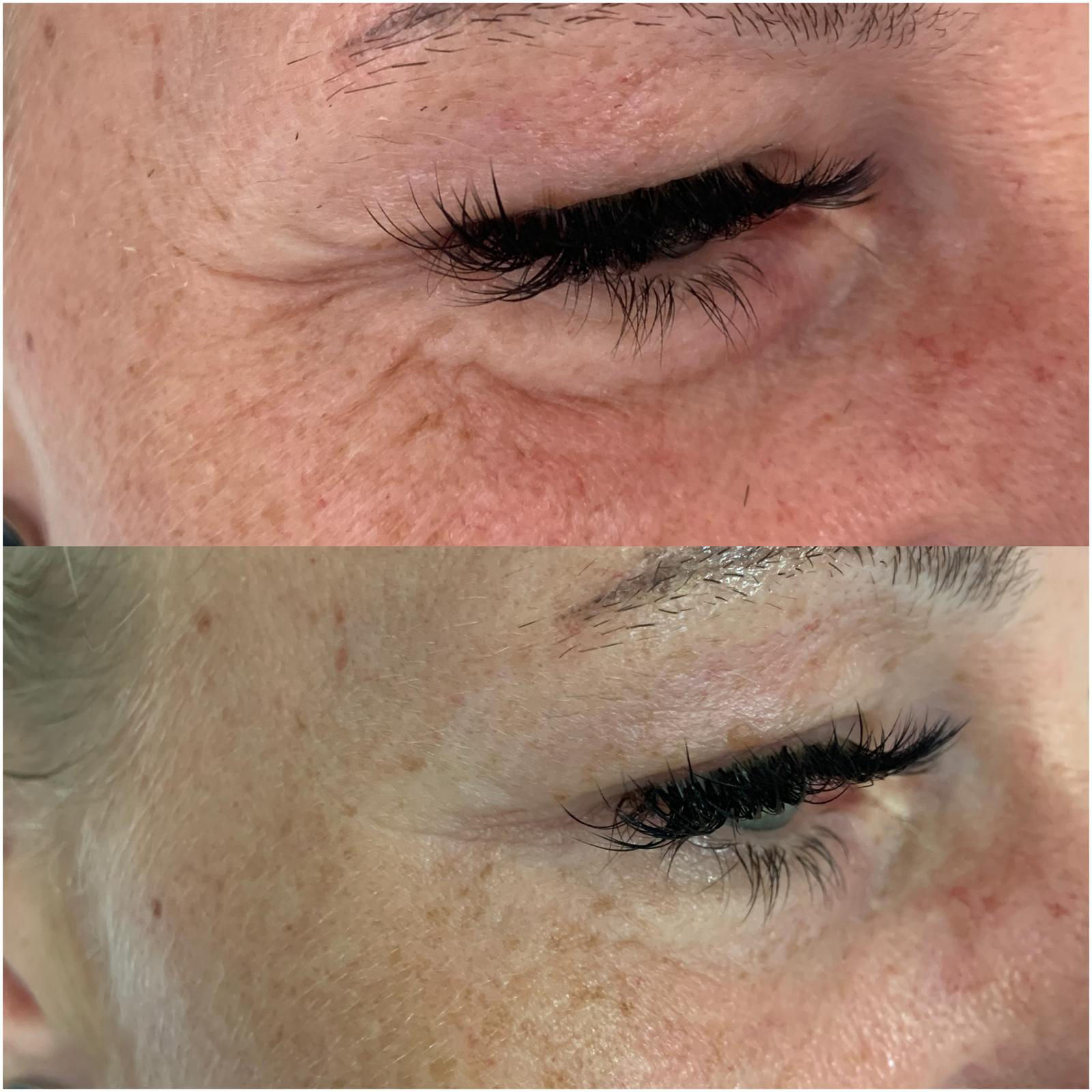 FUTURACONTOUR® Antiaging ohne Nadeln Thüringen Studio MK Beauty Art Bad Langensalza